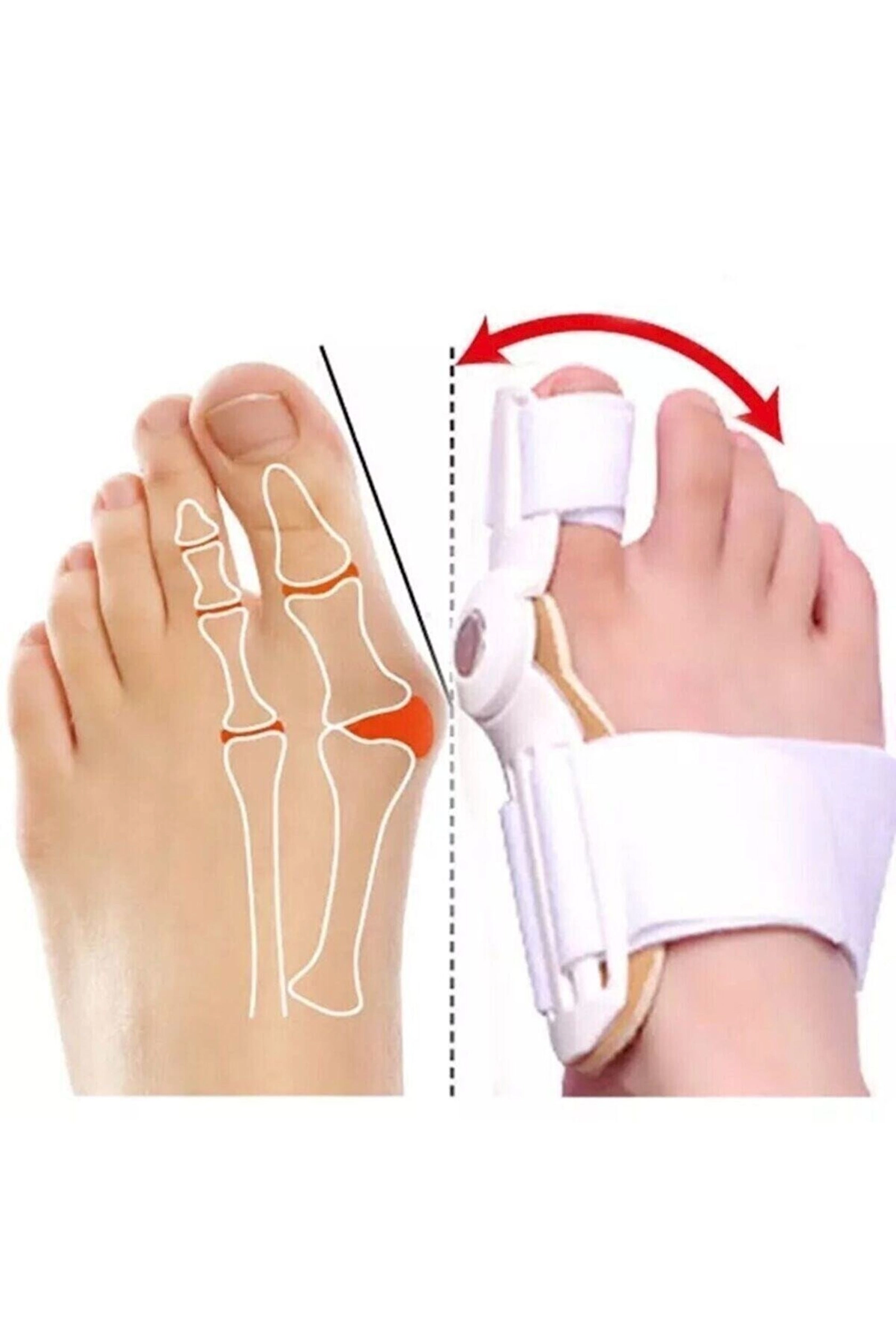 Baş barmağın korreksiyası üçün ortopedik fiksator PR0986, ağ